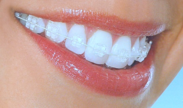 White Patches on Teeth After Braces 1