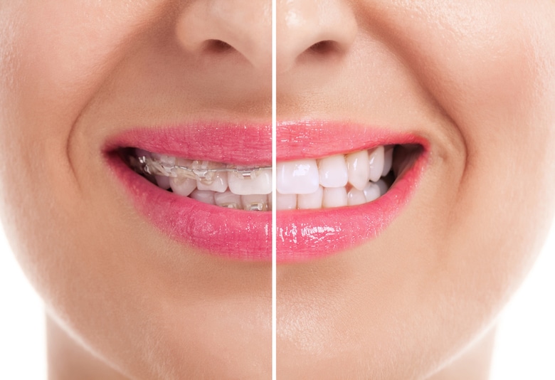 White Patches on Teeth After Braces