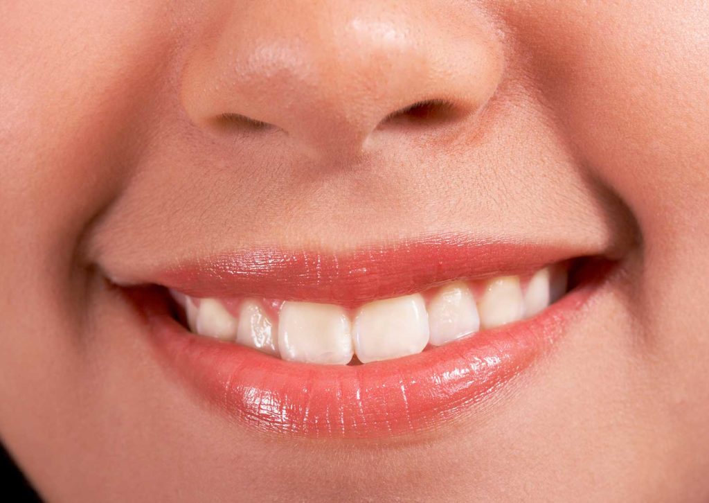 Whitening Spots on Teeth