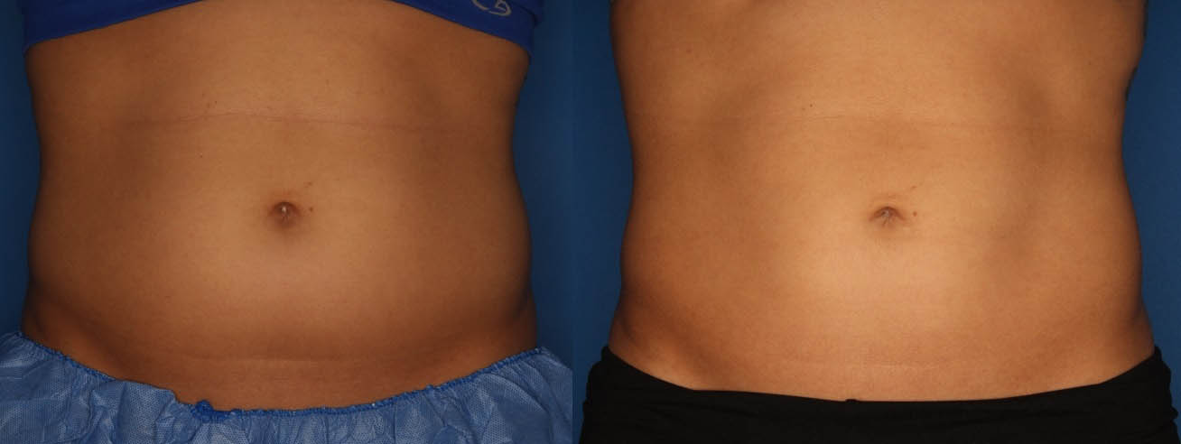 Kybella Stomach Before and After