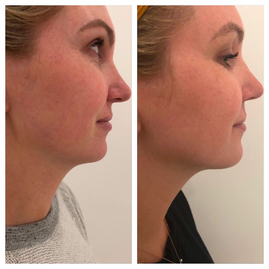 Kybella before And After Day 1 Treatment