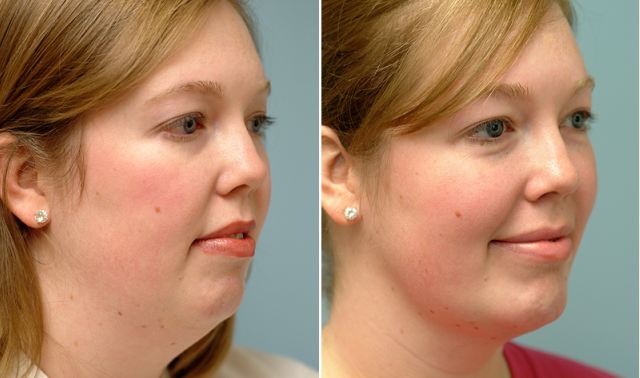 double chin removal before and after