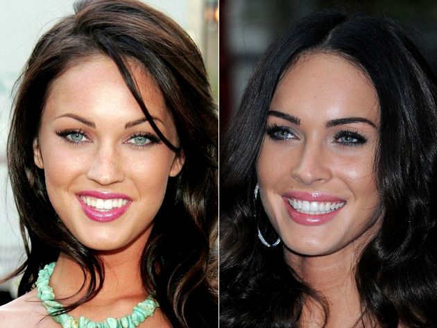 Celebrities Dental Implants Before And After 