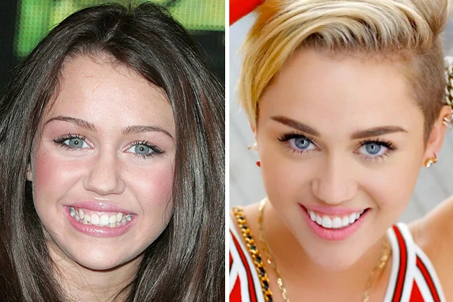 miley cyrus teeth before and after